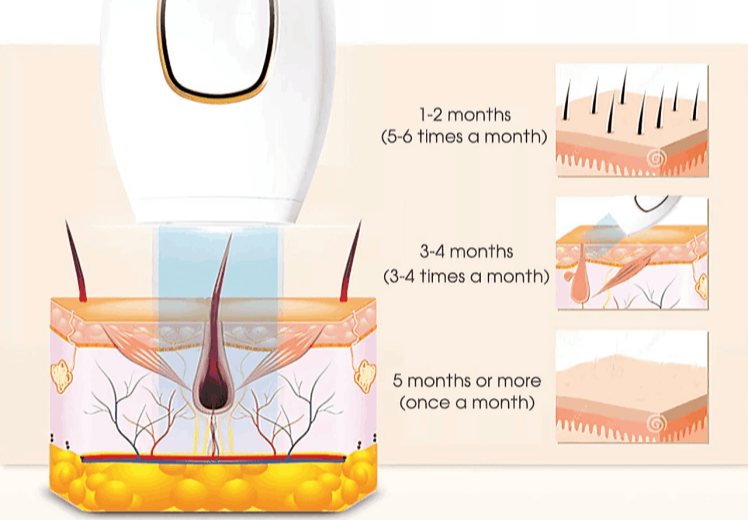 LoweSkin Laser Epilator